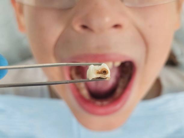 Best Emergency Treatment for Toothache in Oglethorpe, GA